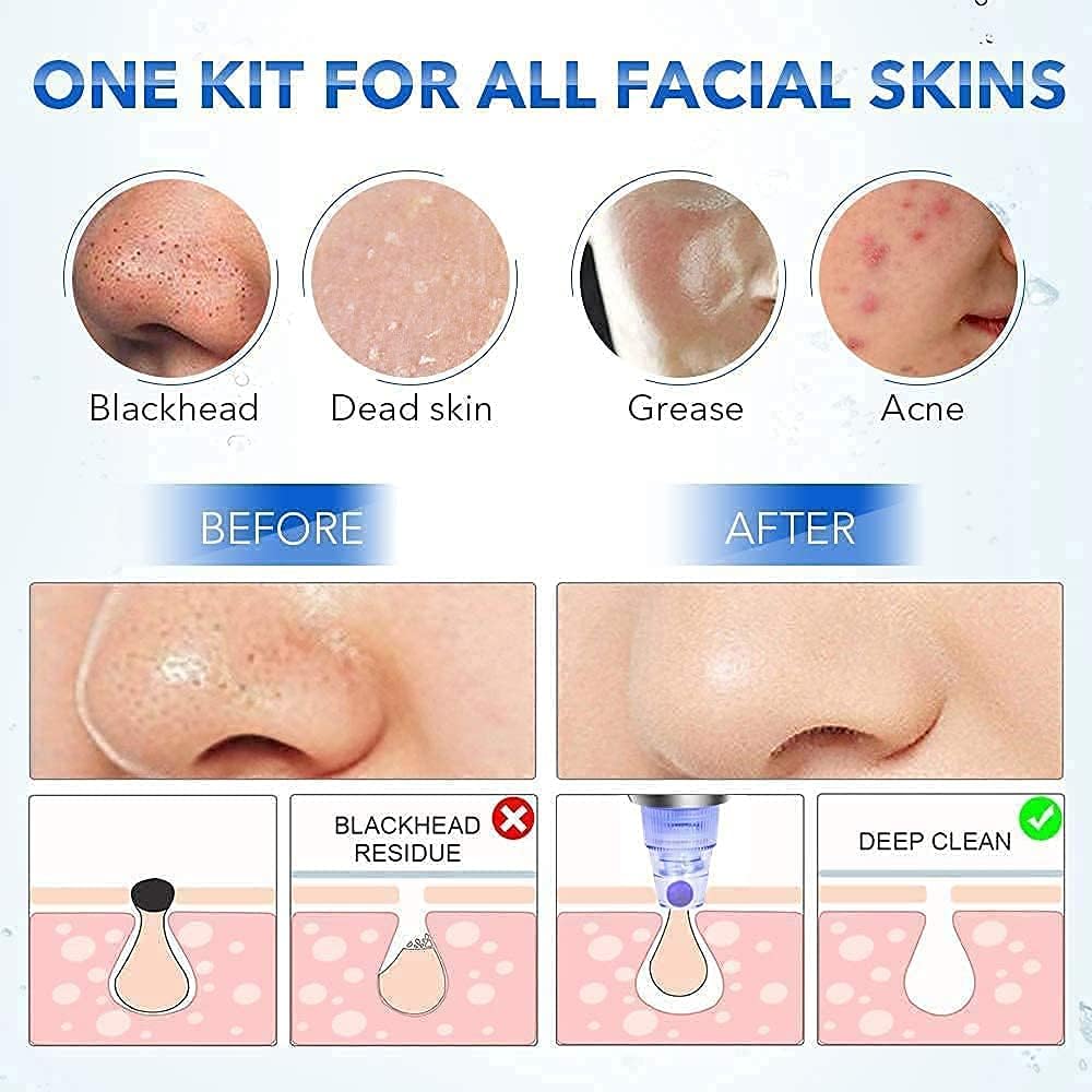 Derma Suction Blackhead Remover Vacuum Pimple Sucker Tool For Men And Women Blackheads Remover Tool Kit, Acne Remover, Pore Cleaner, Facial Beauty Care